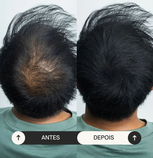 Batci Hair - Recupere o seu cabelo em minutos! (Compre 1 Ganhe 2)