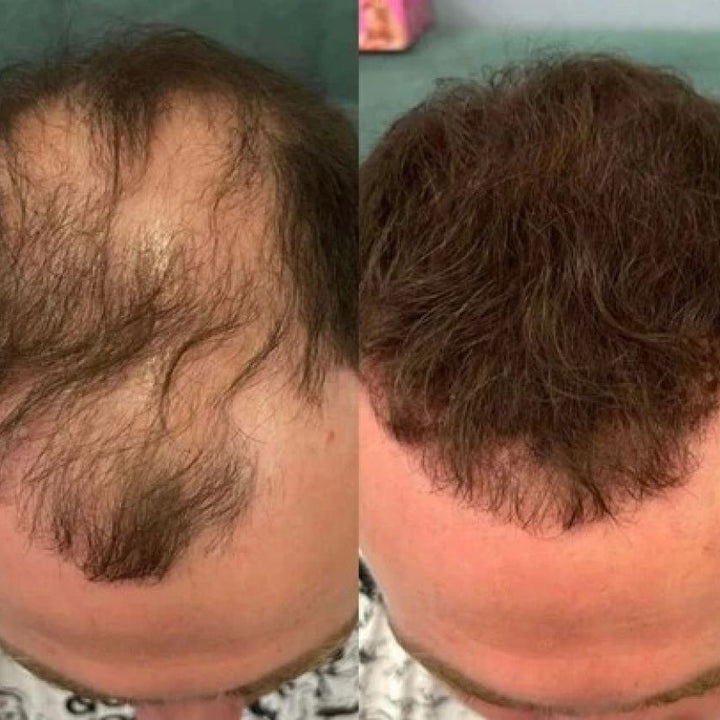 Hair Cover - Preenchimento Capilar em 1 Minuto!