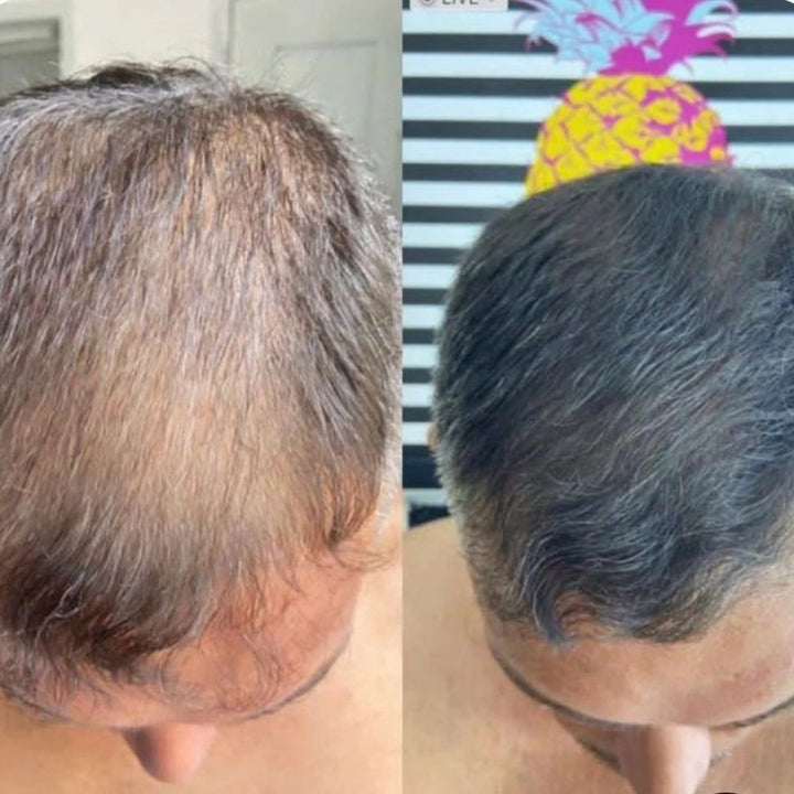 Hair Cover - Preenchimento Capilar em 1 Minuto!